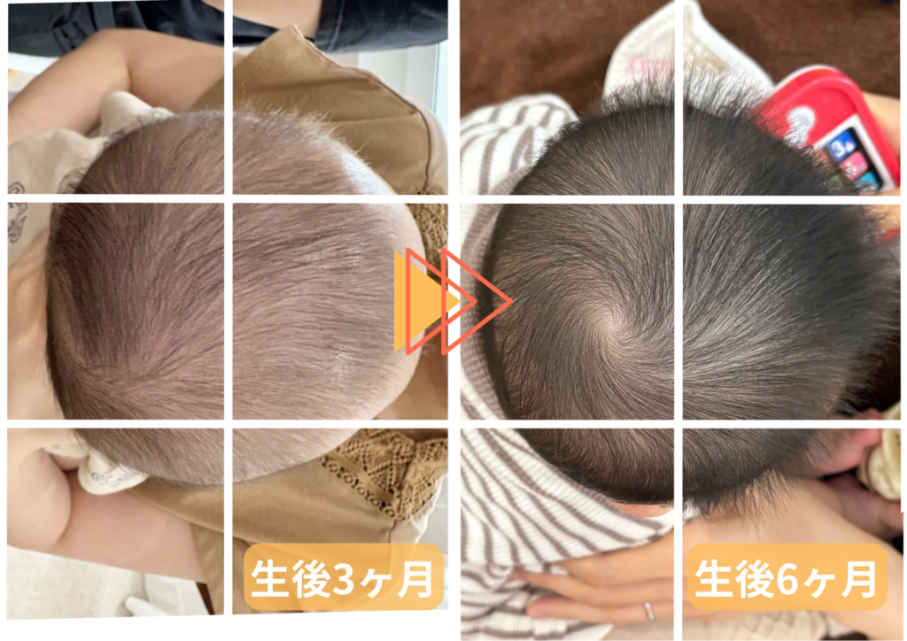 生後3ヶ月児の頭の形の変化